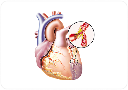 İskemik ürək xəstəlikləri